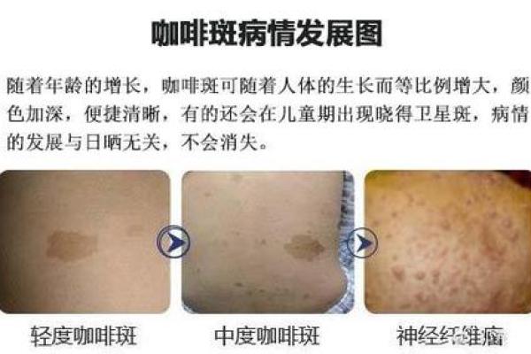 怎么看胎记算命-