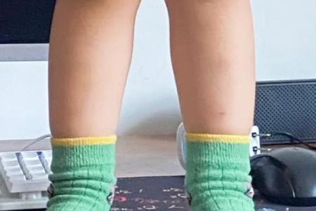 小孩走路内八字或者外八字有问题吗？该如何纠正？