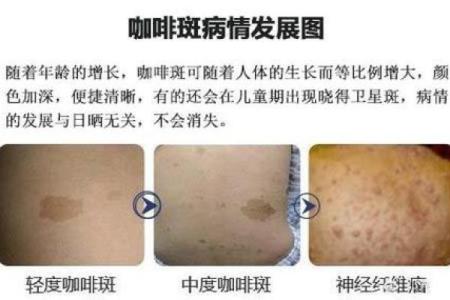 怎么看胎记算命-