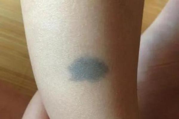 后背胎记算命