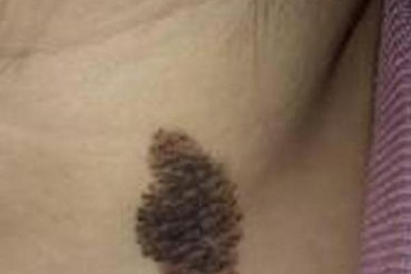 胎记位置算命看运势