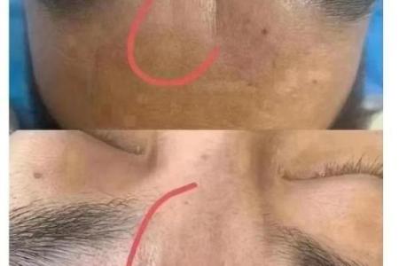 男人印堂八字纹的命运