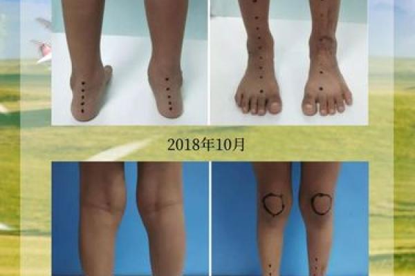 内八字危害