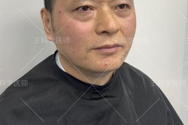 八字眼袋