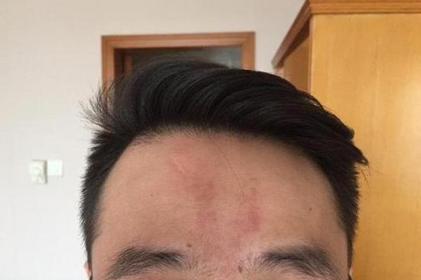 脸上胎记算命看运势