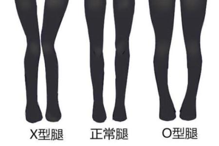内八字腿型