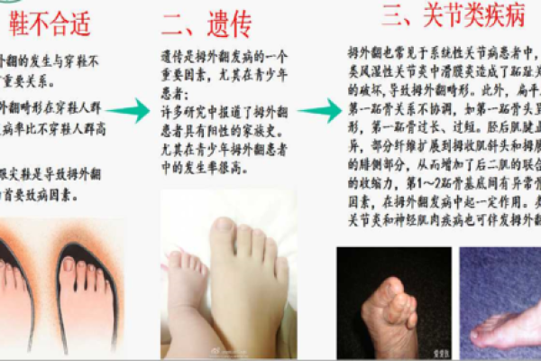 外八字危害