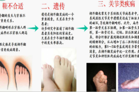 外八字危害