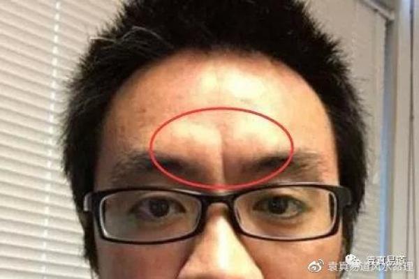 后脑勺有三条竖杠 后脑勺头皮三条竖纹算命