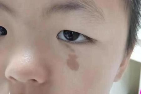 脖子上不同位置胎记算命